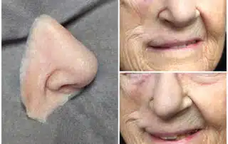 Close up of nasal prosthesis and blending in place on female patient