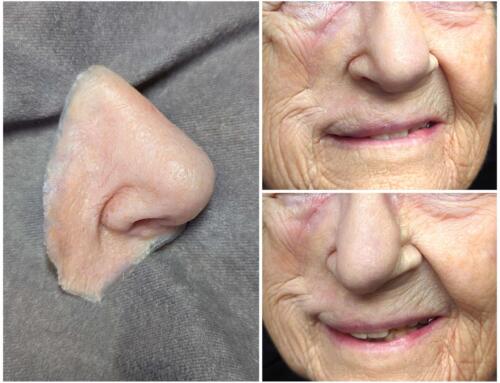 A New Nose Prosthesis and a New Life Outlook for 2024