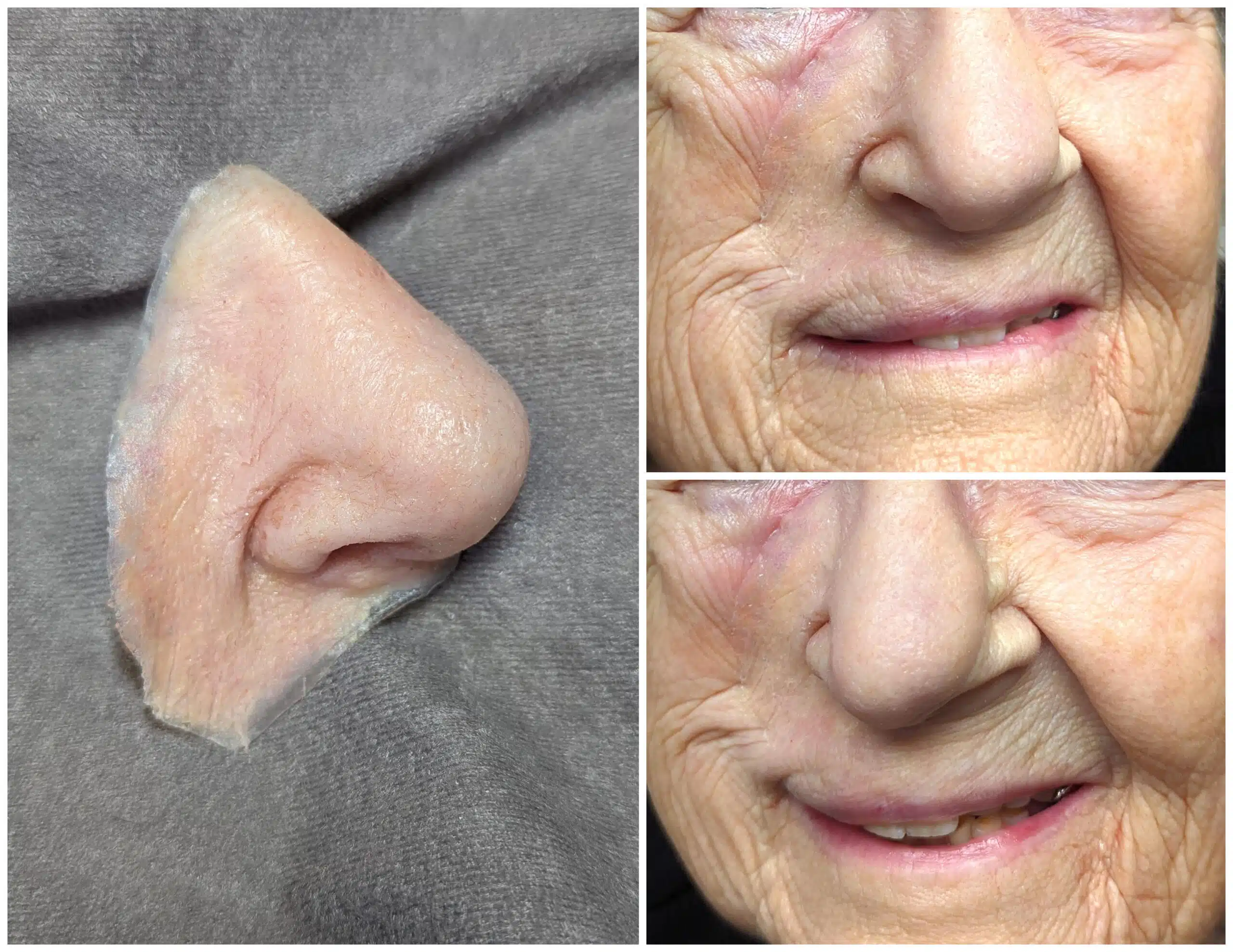 A woman 's face with wrinkles and aging.