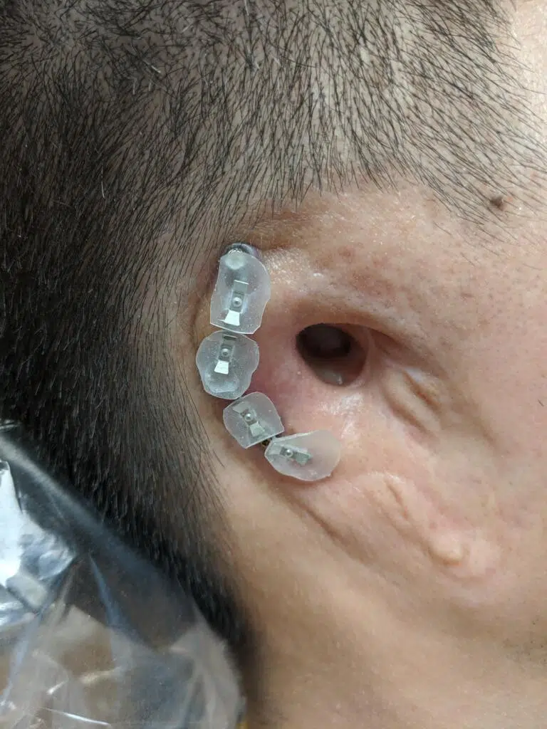 Close up of clips on an osseointegrated bar that anchors an Asian man's ear prosthesis