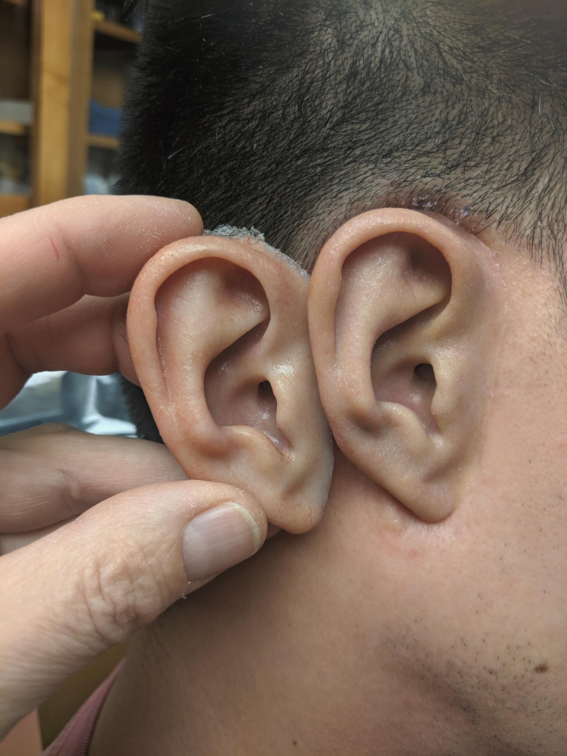 Close up of a fresh replacement implant-retained ear prosthesis in place on Aisian man, and his older prosthesis that was retinted held close for comparison.