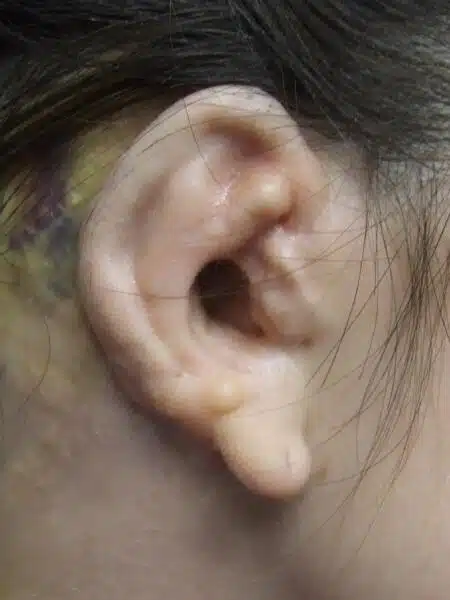 Suboptimal rib cartilage ear reconstruction