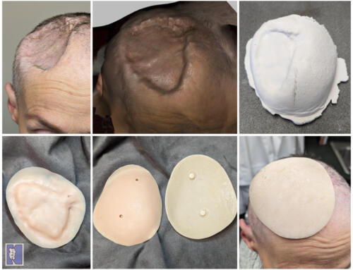 Craniofacial Prosthesis Protects the Brain of Wisconsin Woman