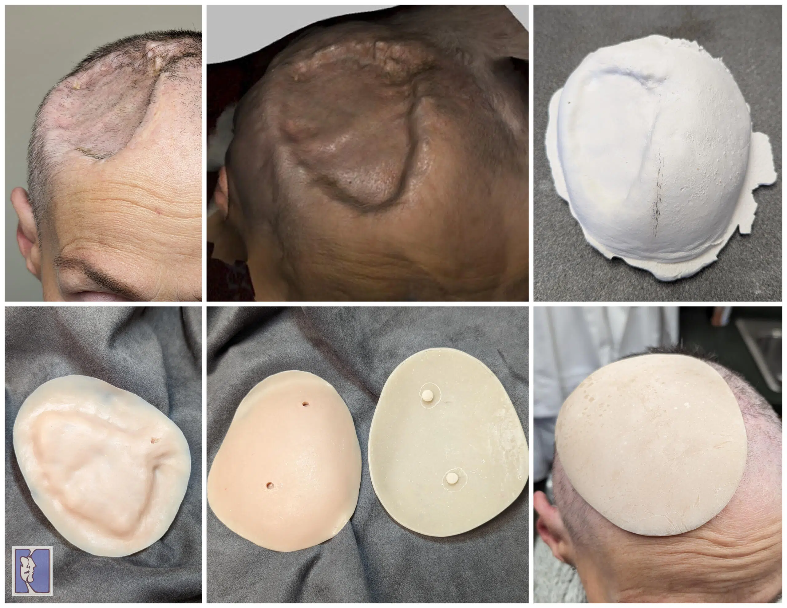 A collage of photos showing different types of hair loss.