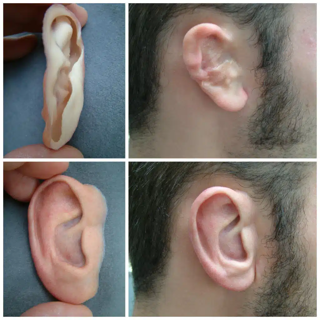 Close-up photo of young man wearing his silicone ear prosthesis over his grade 2 microtia with imperceptible margins