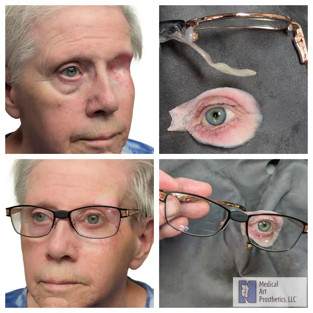 Woman wearing an eye prosthesis held in place by her glasses