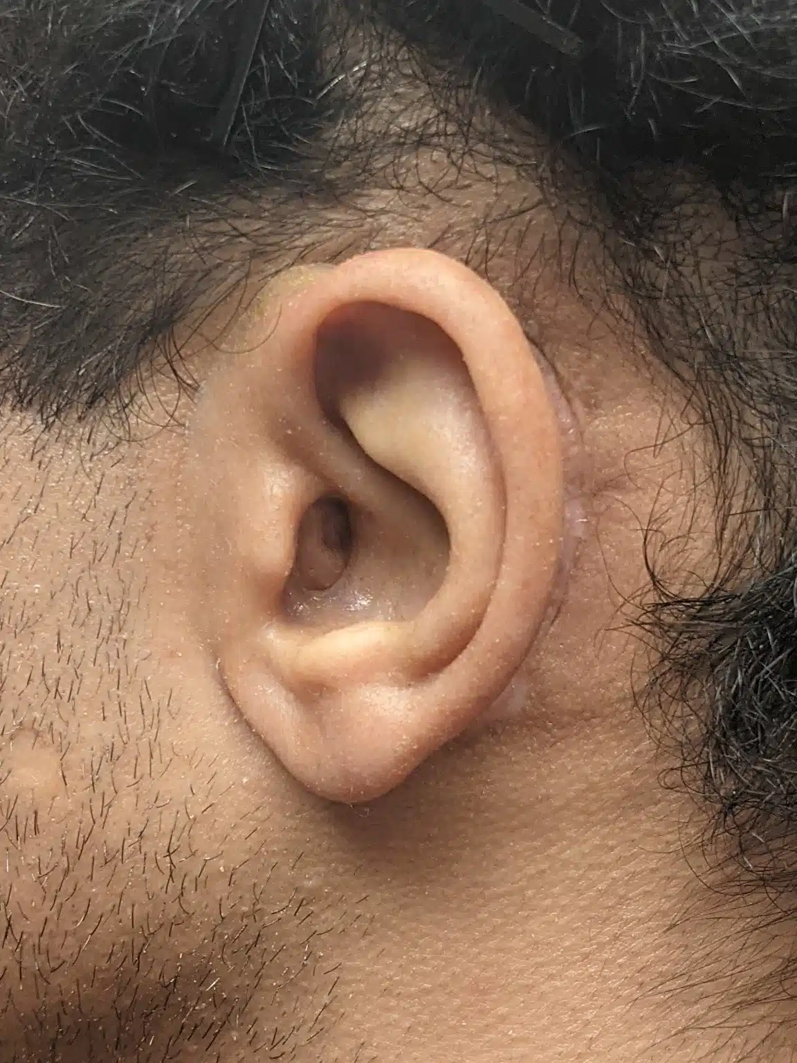 Close up photo of patient's new magnetic silicone ear prosthesis in place and seamlessly blending with surrounding skin