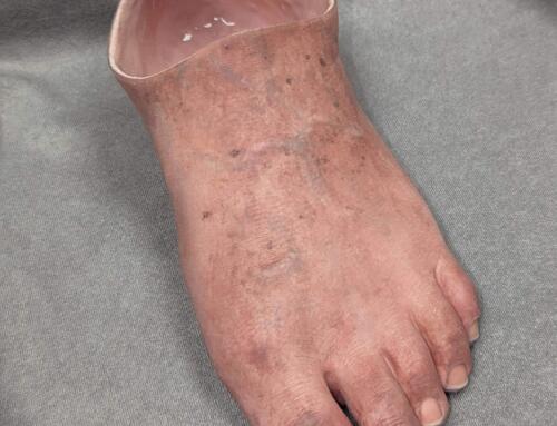 New silicone partial foot prosthesis