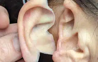 Ear prosthetic next to surgery ear