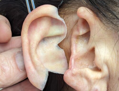Elegant Ear Prosthetic Repairs Tissue Loss From Mohs Cancer Surgery