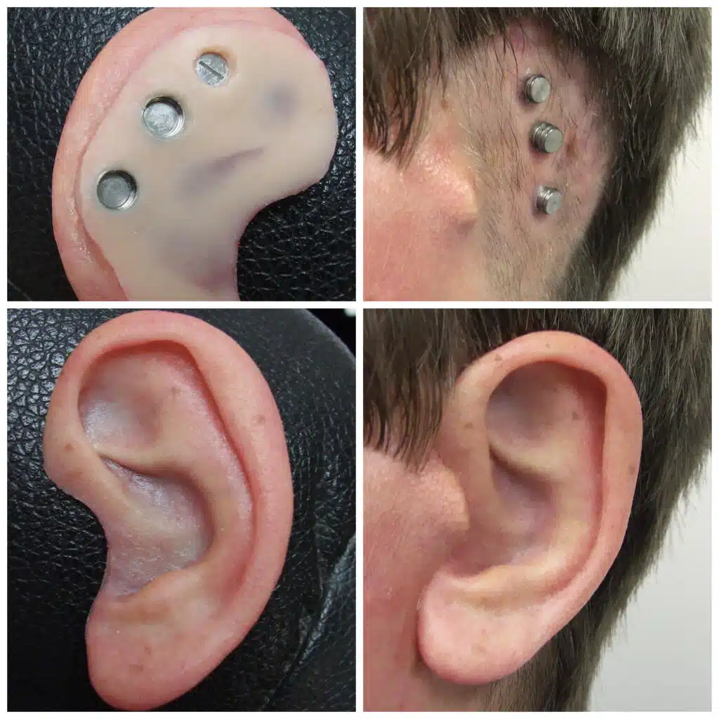 Images of young man with osseointegrated abutments and with his magnetic ear in place