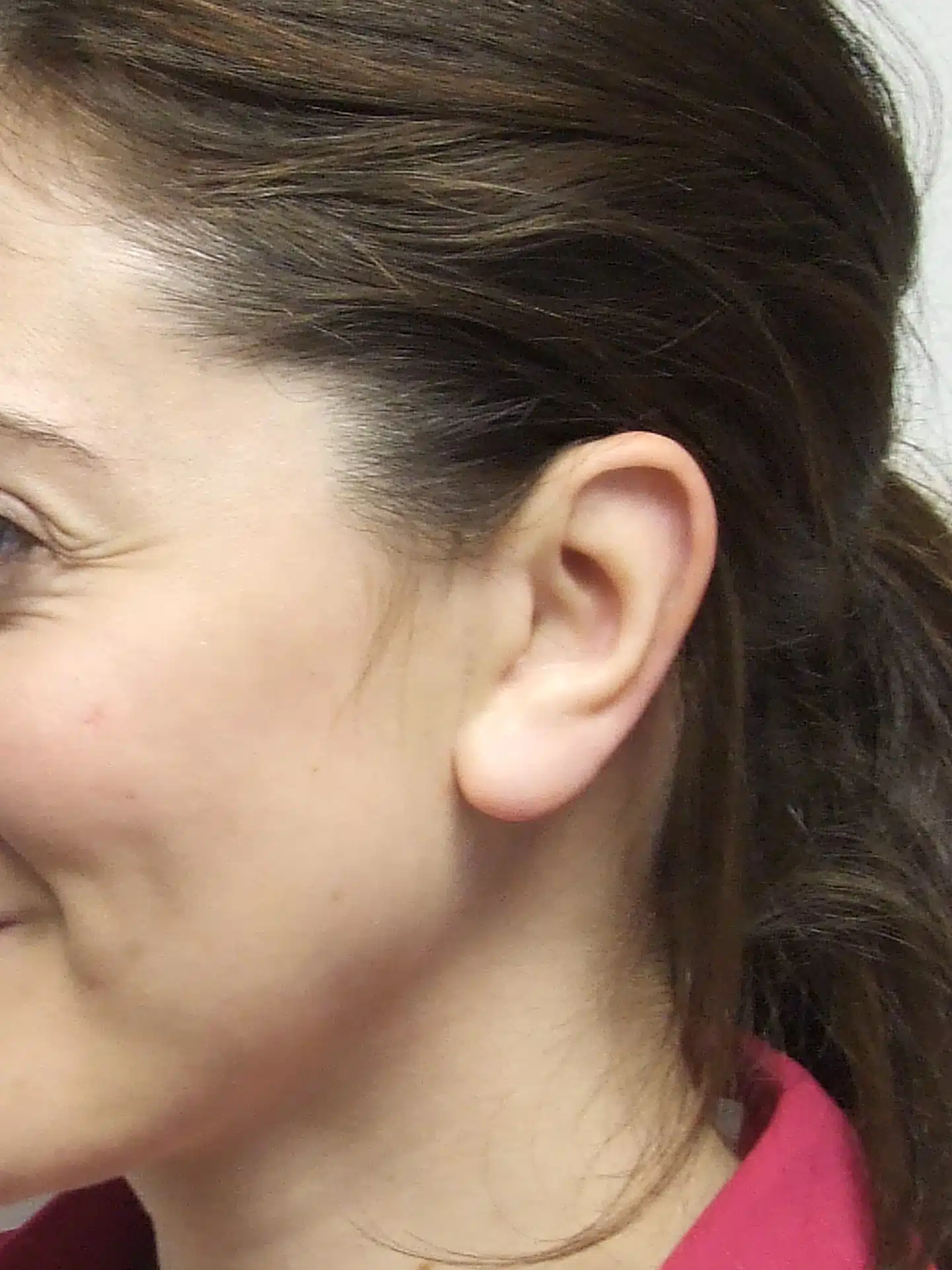 Photo of girl smiling with slipover ear prosthesis covering her poorly defined rib cartilage ear