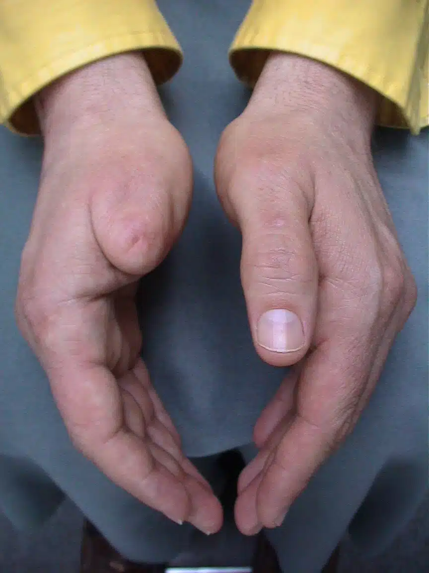 A person 's hands are shown loss of thumb.