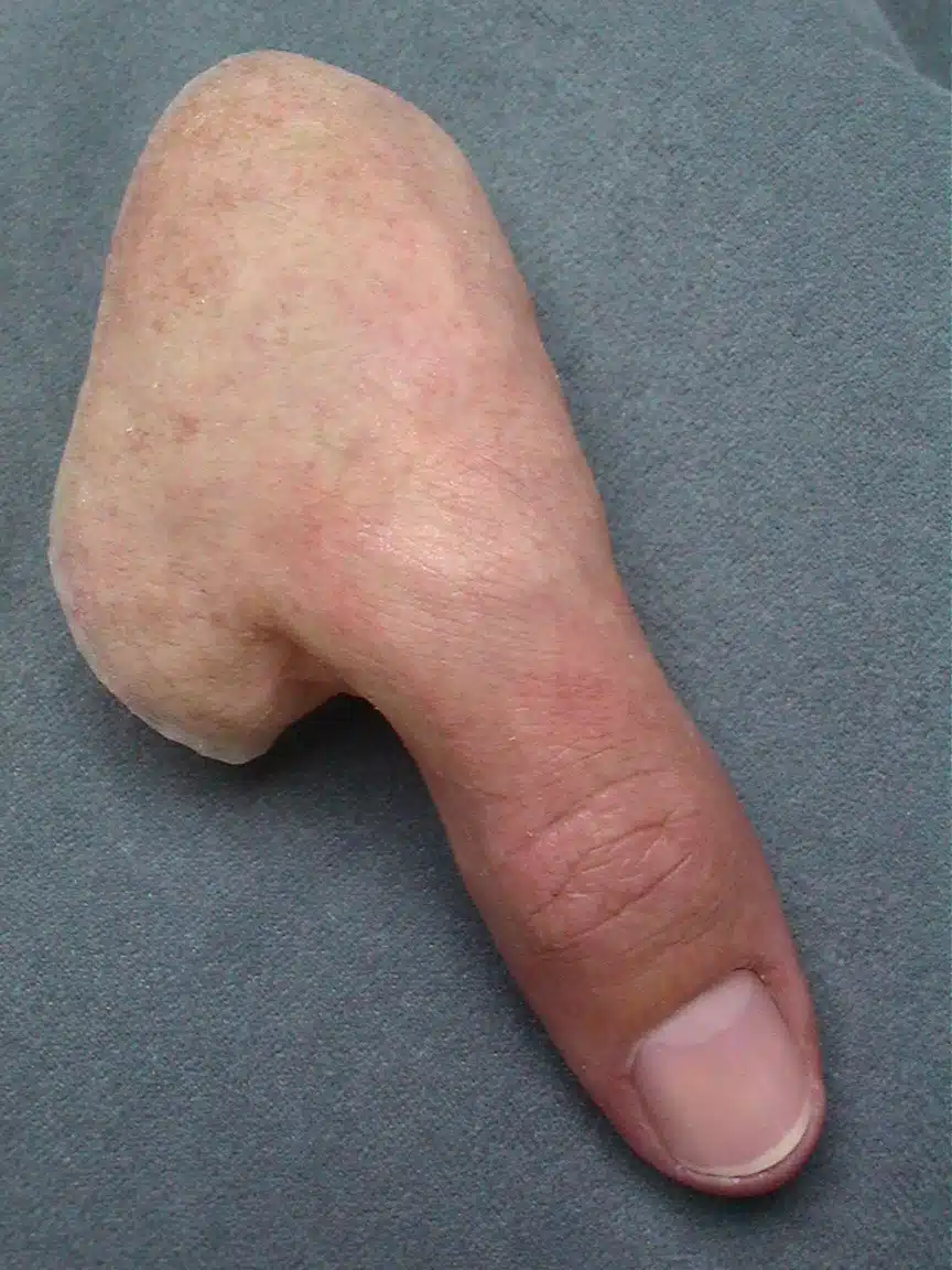 A close up of a complete thumb prosthesis.
