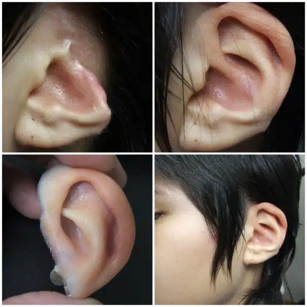 Young woman upper half of ear missing and with perfect matching ear prosthesis in place