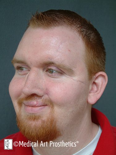 nasal-results