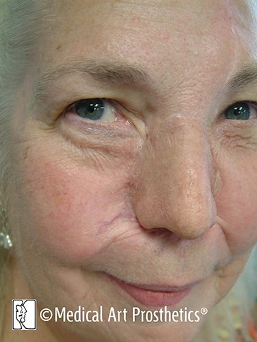 nasal-results2