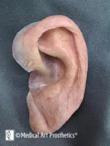left ear prosthesis