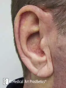 Close-up of ear prosthesis in place restoring natural ear appearance