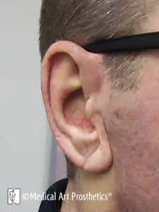 Close-up of ear prosthesis in place with glasses in place helping to retain the prosthesis and correct alignment