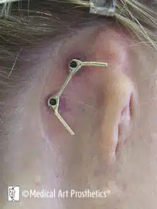 bar-splint framework on osseointegrated ear implants