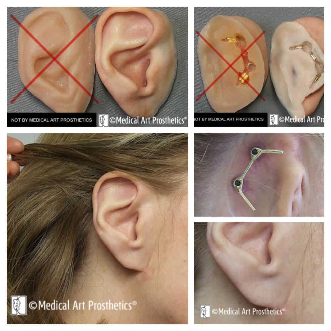 auricular-patient-stories-chris-k