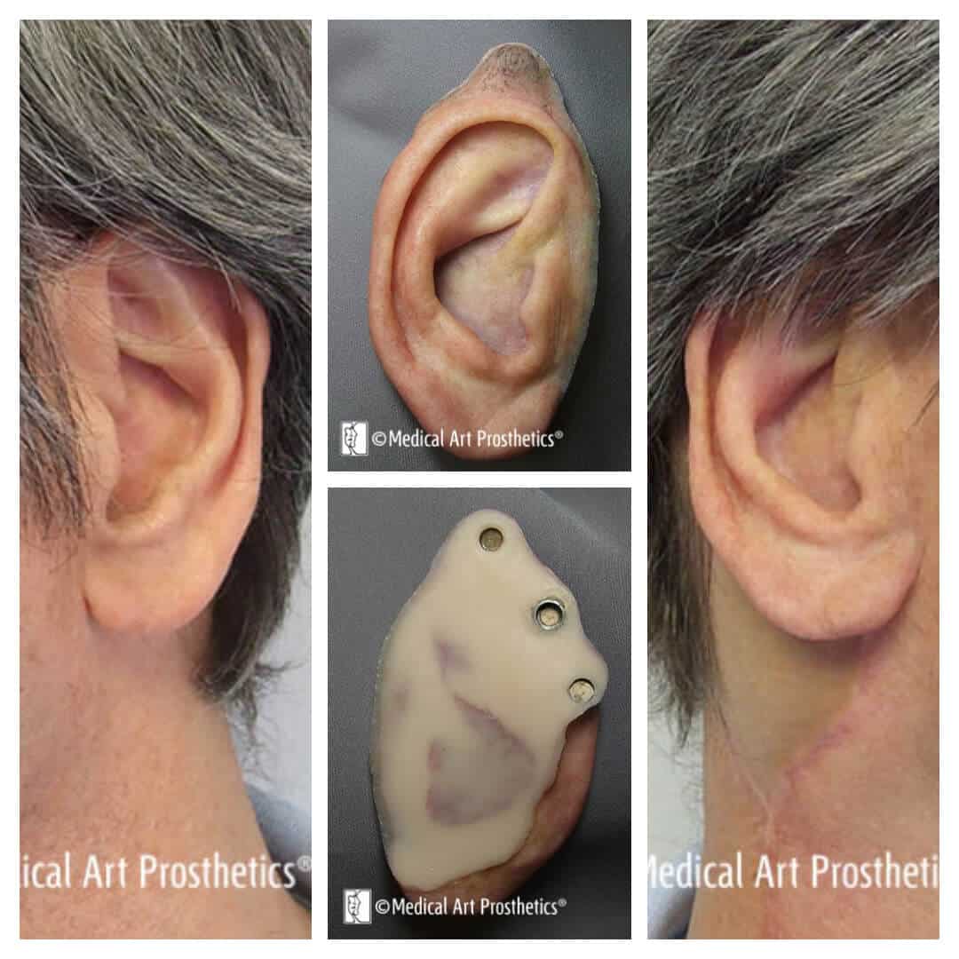 auricular-patient-stories-hf