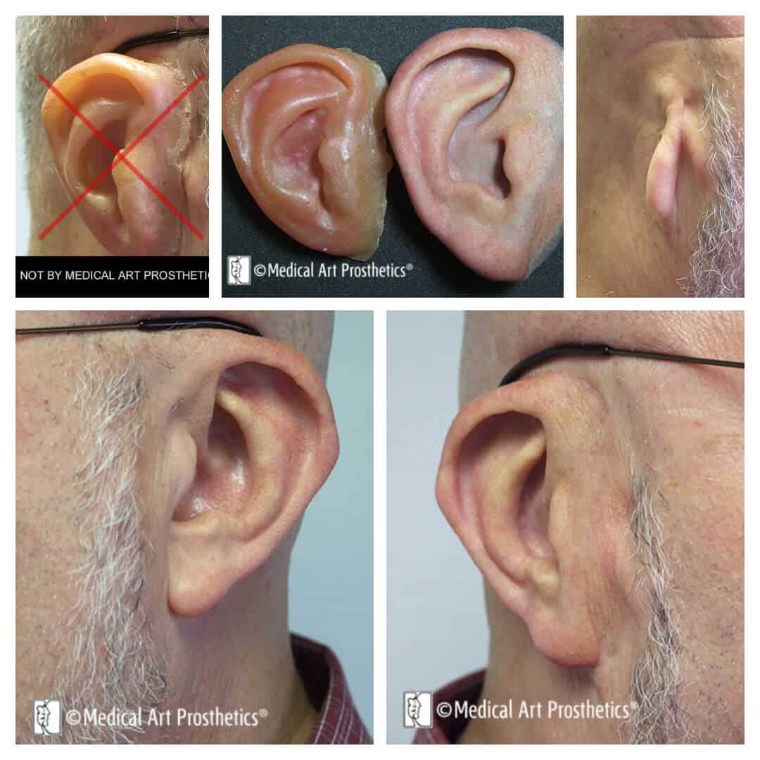 auricular-patient-stories-lynnb