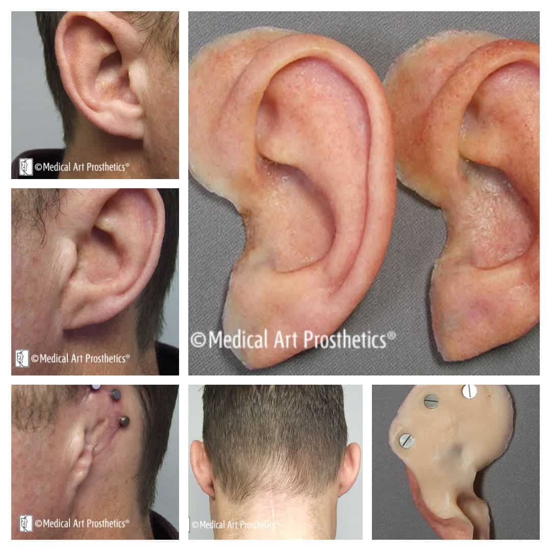 auricular-patient-stories-michael