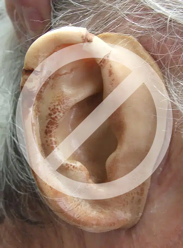Photo of cracked ear prosthesis made of poor material on patient