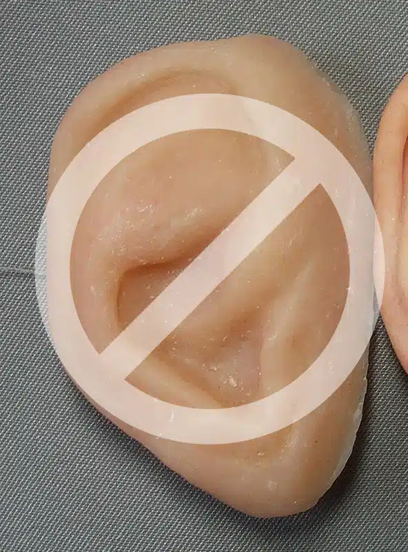 Photo of poorly shaped ear prosthesis