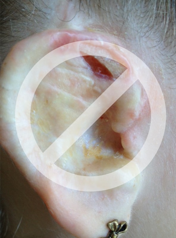 auricular-suboptimal-8