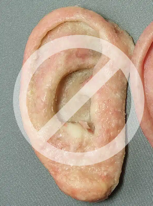 Photo of poorly tinted ear prosthesis with unrefined surface texture
