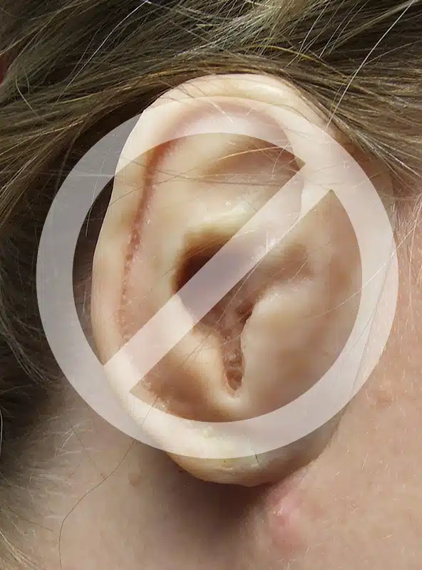 Photo of crudely fabricated ear prosthesis on patient