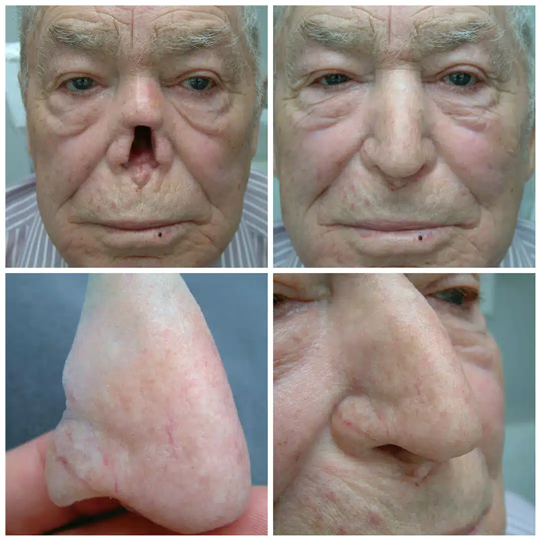 Nose Photo Gallery – Medical Art Prosthetics