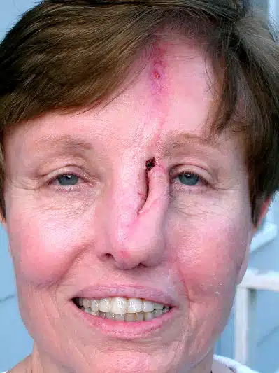 A woman with a large, broken nose and one eye missing.