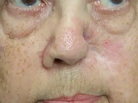 A close up of an older person 's face with redness.