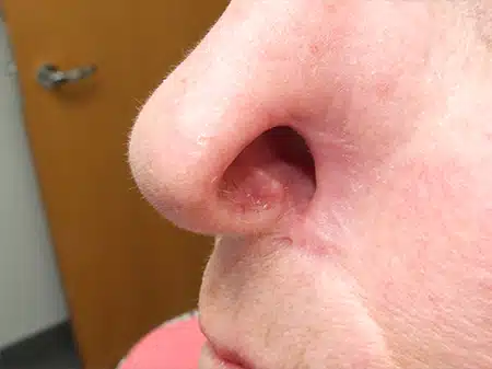 A person with a nose ring and a small hole in the middle of their nose.