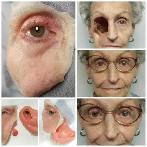 A collage of old woman 's face with various eye and nose surgeries.