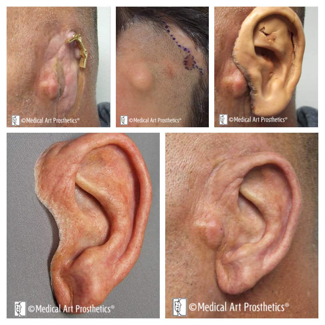patient-stories-auricular-anthony