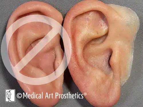 A person 's ear with an injury on it.