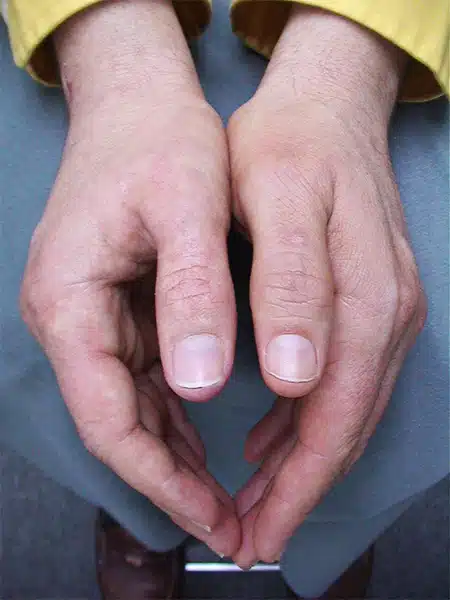 man's hand with a lifelike thumb prosthesis