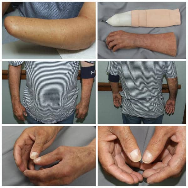 A man with a bandaged arm and hands.