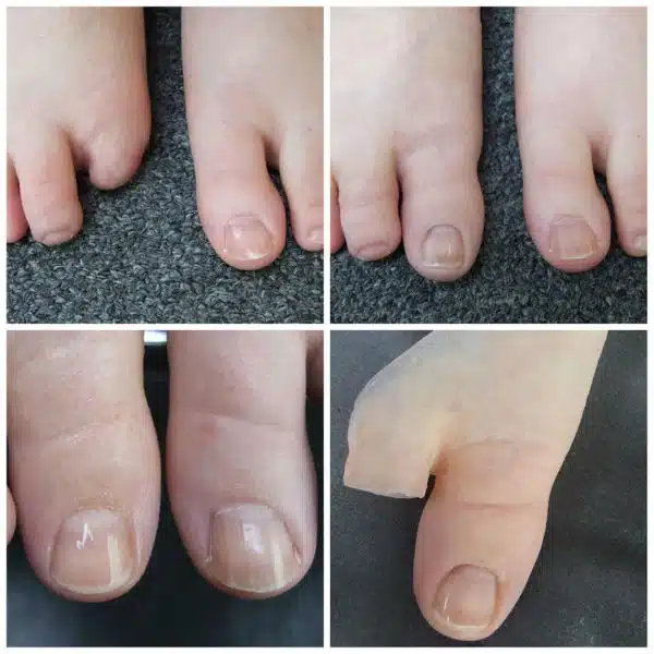 A collage of four pictures with different foot types.