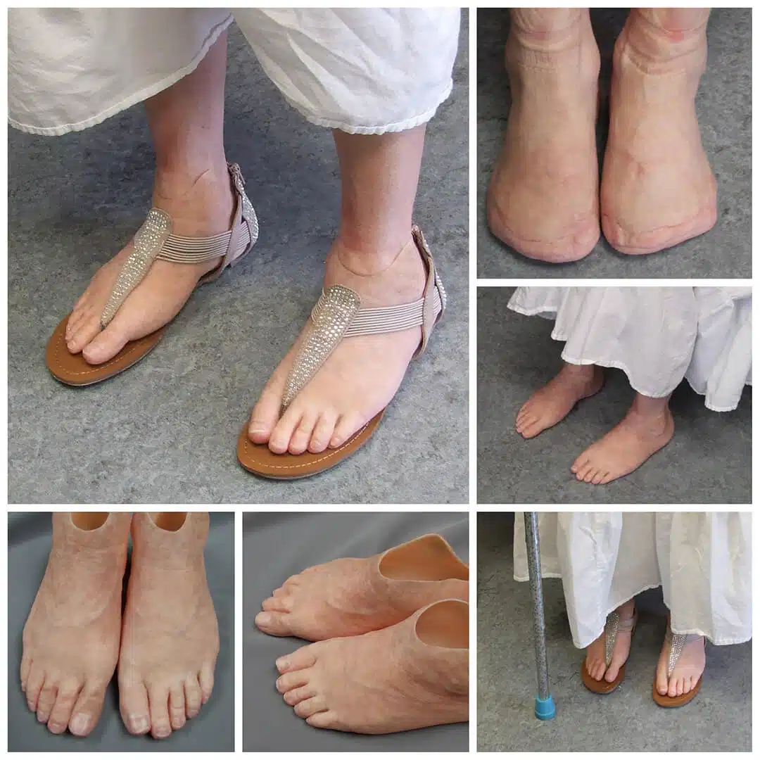 Toe Foot Photo Gallery Medical Art Prosthetics