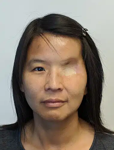 A woman with an eye injury and black hair.