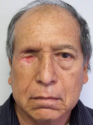 A man with an eye injury is shown.