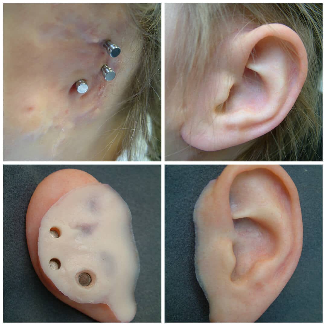 Auricular Photo Gallery Medical Art Prosthetics