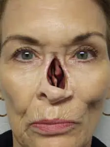 A woman with an open nose and no eye.