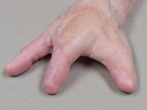 Somatic - Finger & Hand Prosthetics – Medical Art Prosthetics